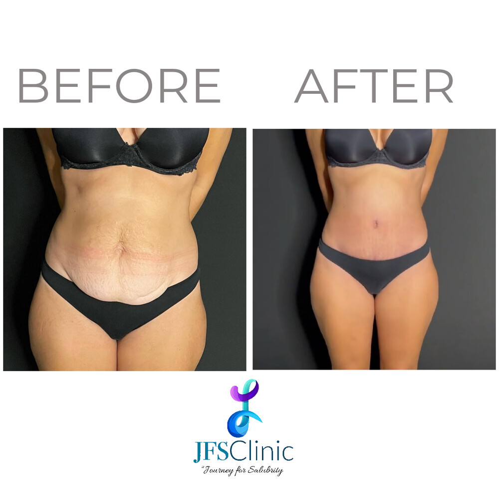 Before and After Result